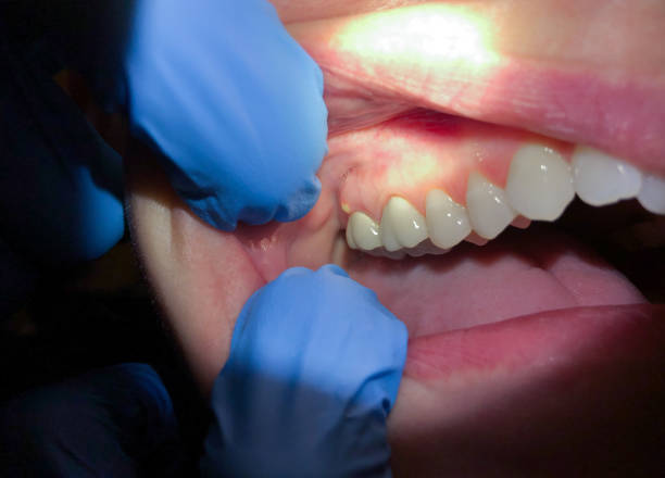 Best After-Hours Emergency Dentist in Wollochet, WA