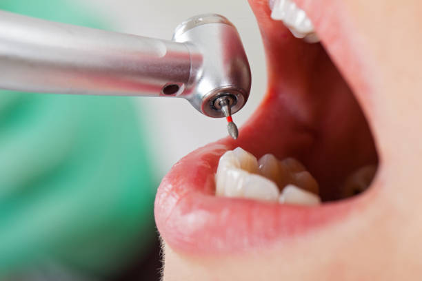 Best Emergency Tooth Extraction in Wollochet, WA